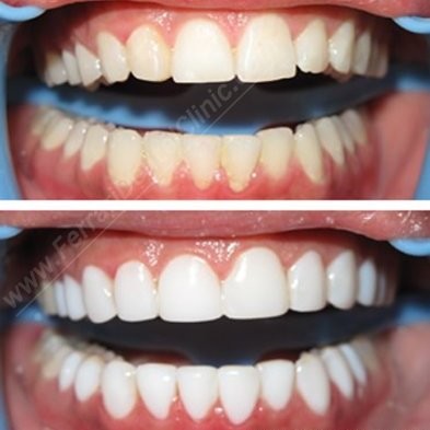 Teeth Whitening Lebanon